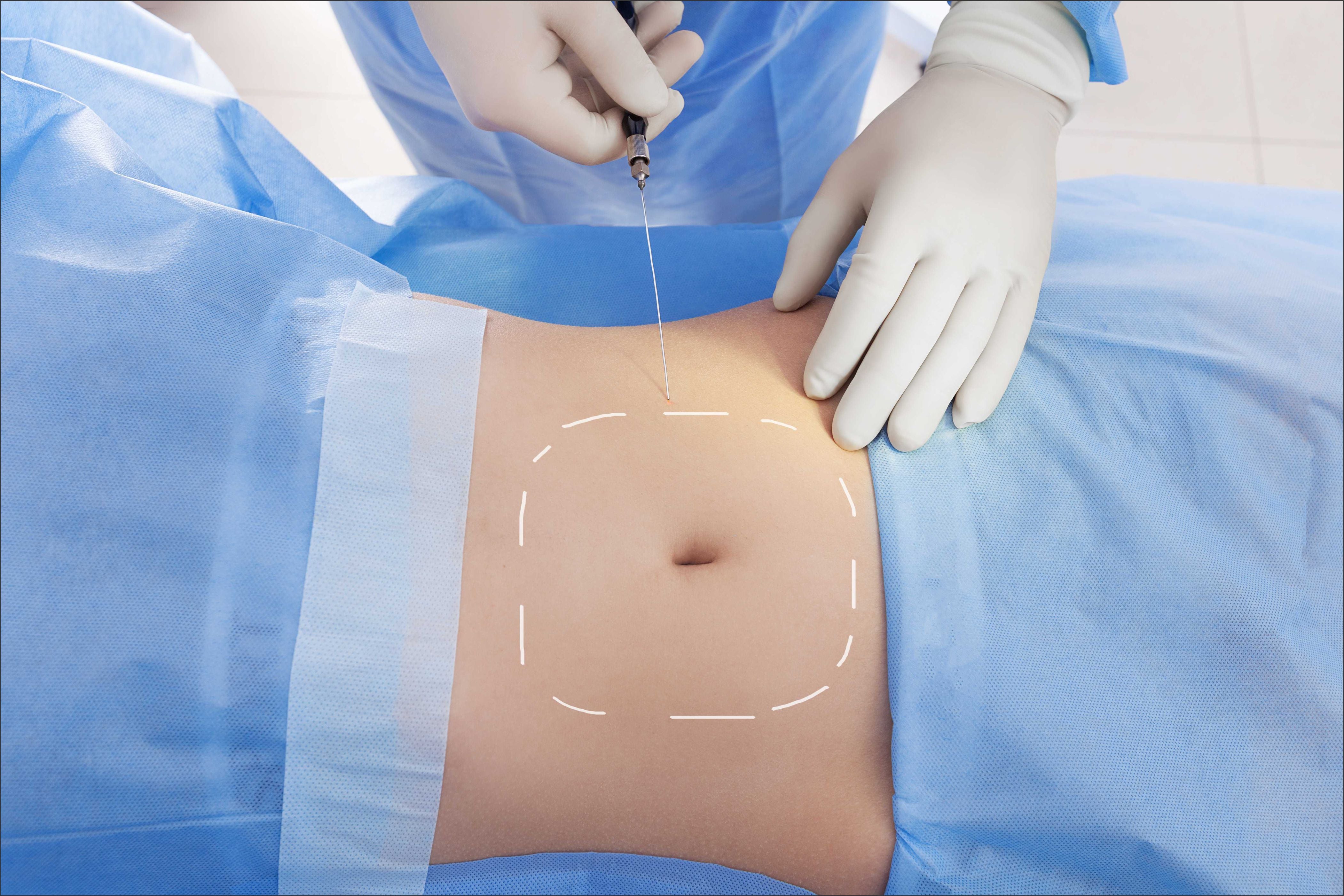 What to Expect: Liposuction Recovery Time and Tips.