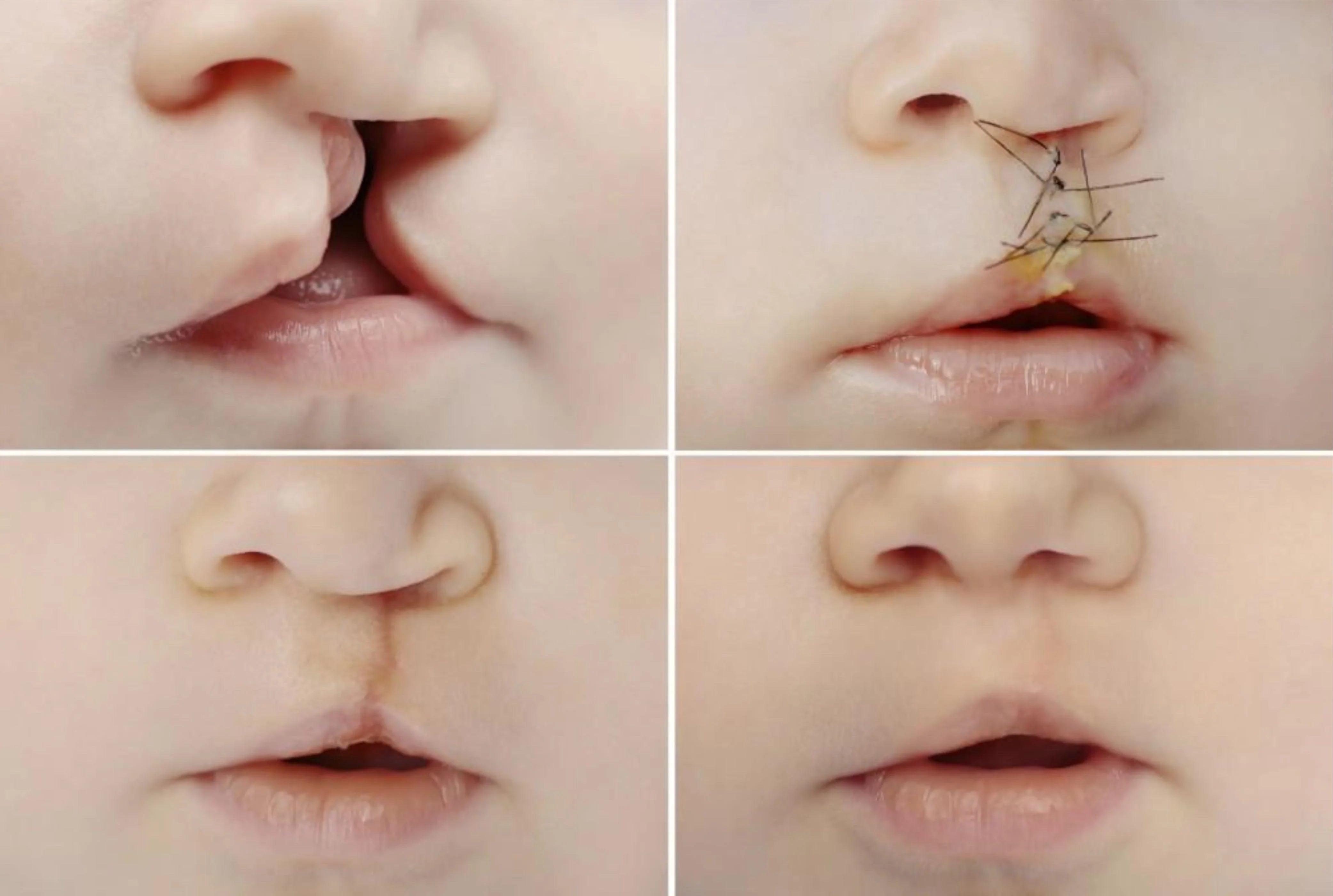 Understanding Cleft Lip and Palate: What to Expect Before, During, and After the Procedure - Ameri Surgical Instruments Inc.